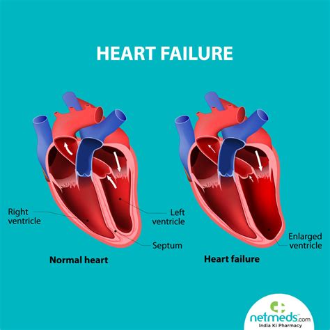 lv dysfunction meaning|what is severe lv impairment.